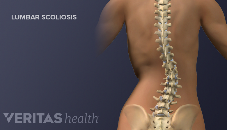 Illustration of a adult spine showing scoliosis.