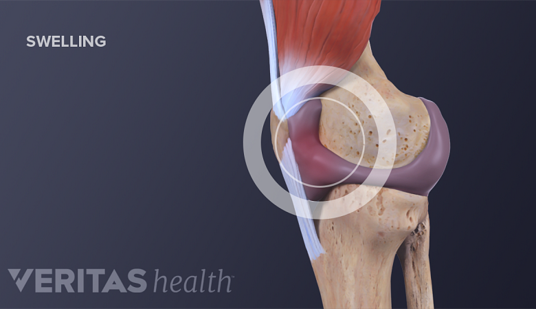 Medical illustration of a swollen knee
