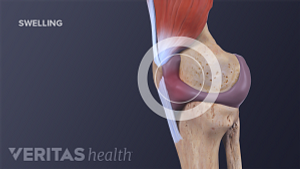 Medical illustration of a swollen knee