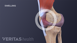 前交叉韧带撕裂导致膝盖肿胀