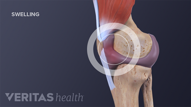 Knee swelling from a torn ACL