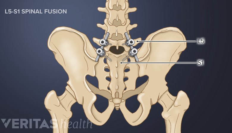Illustration showing pelvis with fused L1-S5 segment.
