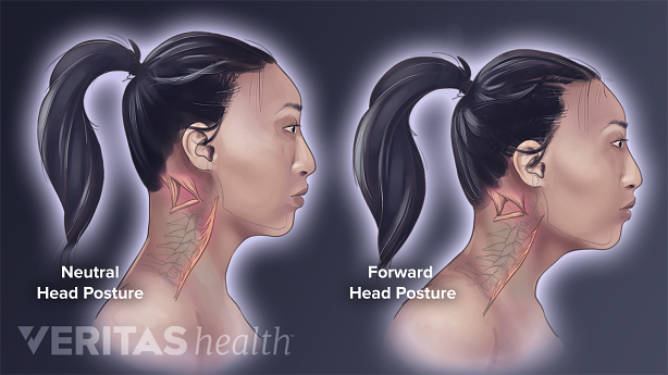 Illustration showing 2 women one with Neutral Head Posture and Forward Head Posture.