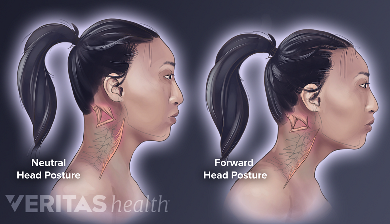 Illustration showing 2 women one with Neutral Head Posture and Forward Head Posture.