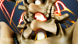 Posterior view of the lumbar showing a laminectomy from spinal stenosis.