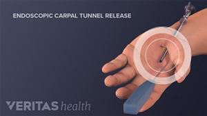 Endoscopic carpal tunnel release