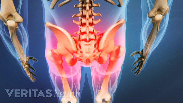 An illustration showing pain in the lower back and buttock area radiating down to the leg.
