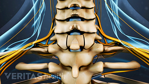 Posterior view of a laminectomy in the cervical spine.