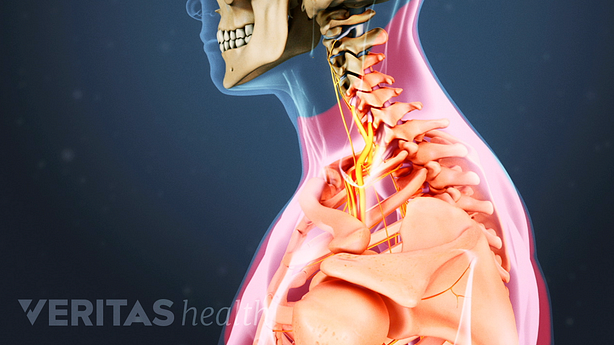 Illustration showing pain areas in the neck and shoulder highlighted in red.