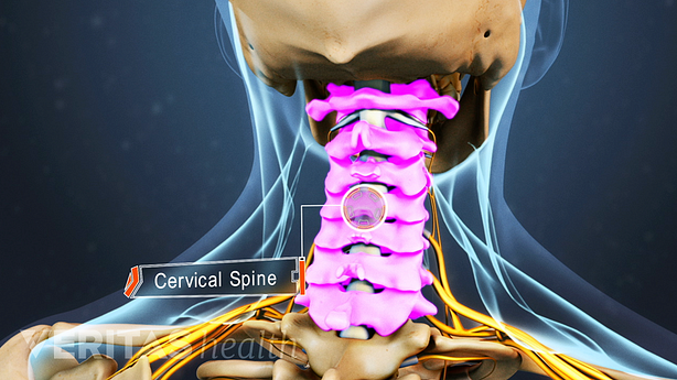 Area of the cervical spine that can cause neck and arm pain