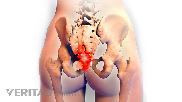 An illustration showing pain in the coccygeal bone.