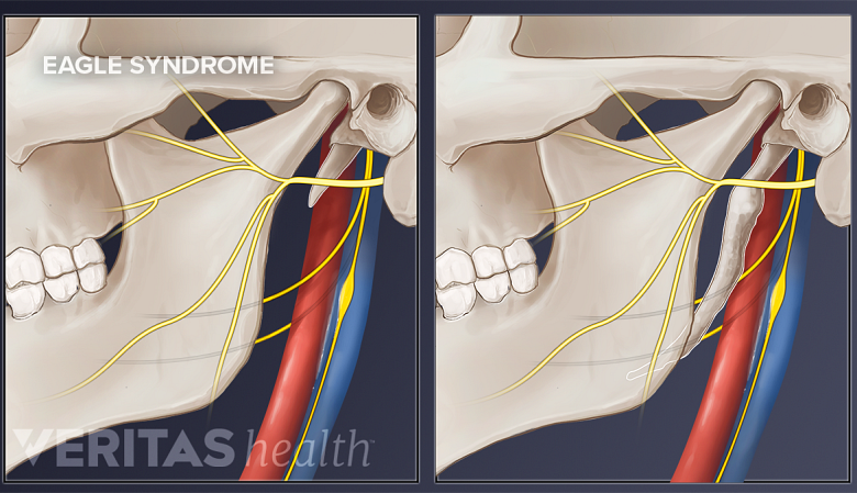 Illustration comparing a normal vs elongated styloid process.
