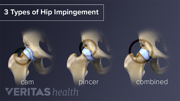 Pain Hip Impingement Impingement) | Sports-health