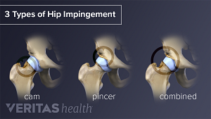 Types of hip impingement include cam, pincer, and combined.