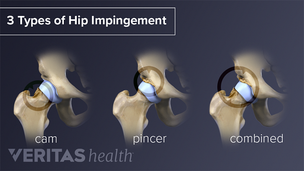 Diagram showing three types of hip impingement: cam, pincer, and combined.