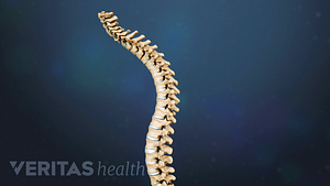 Spinal curvature showing compression fracture