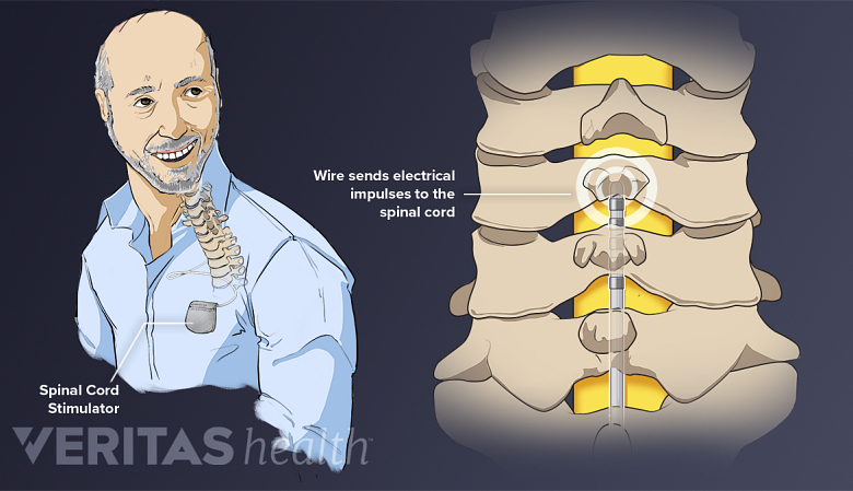 A man with a stimulator in his pocket and cervical spine with a wire inserted.