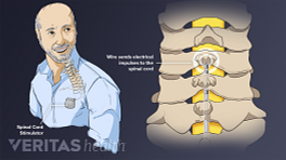 Q&A: Back pain post-surgery? Try a spinal cord stimulator - MultiCare  Vitals Back pain post-surgery? Try a spinal cord stimulator