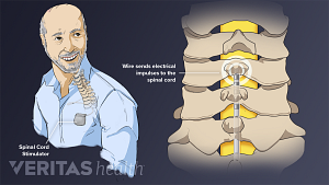 Illustration of man with spinal cord stimulator in his front pocket. Illustration of wire send electrical impulses to the spinal cord.