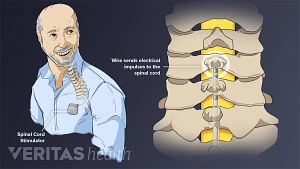 Spinal Cord Stimulation - Acute & Chronic Pain and Spine Center - Amarillo,  TX