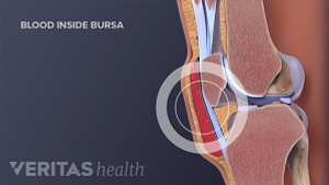 Medical illustration blood inside of a knee bursa