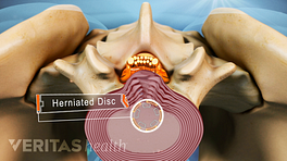 Superior view of a herniated disc.