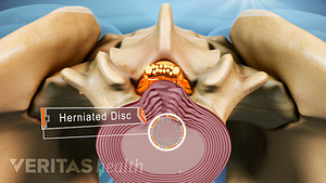 Superior view of a herniated disc.