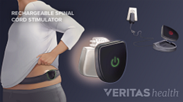A spinal cord stimulator secured around a person’s waist with a belt and ways the charge the device.