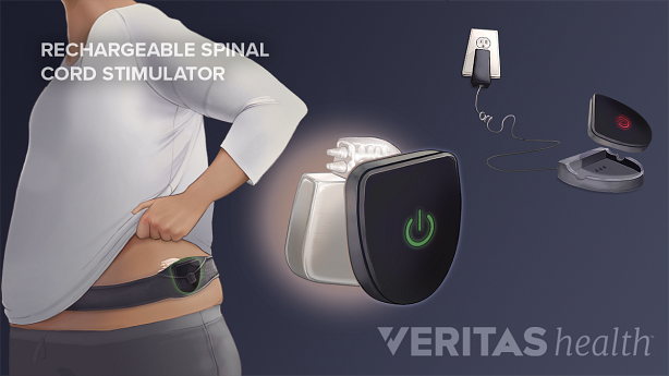 Medical illustration of battery for rechargeable spinal cord stimulator being charged