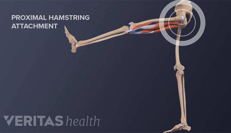 Illustration showing anatomy of hamstring muscle with proximal hamstring attachment.