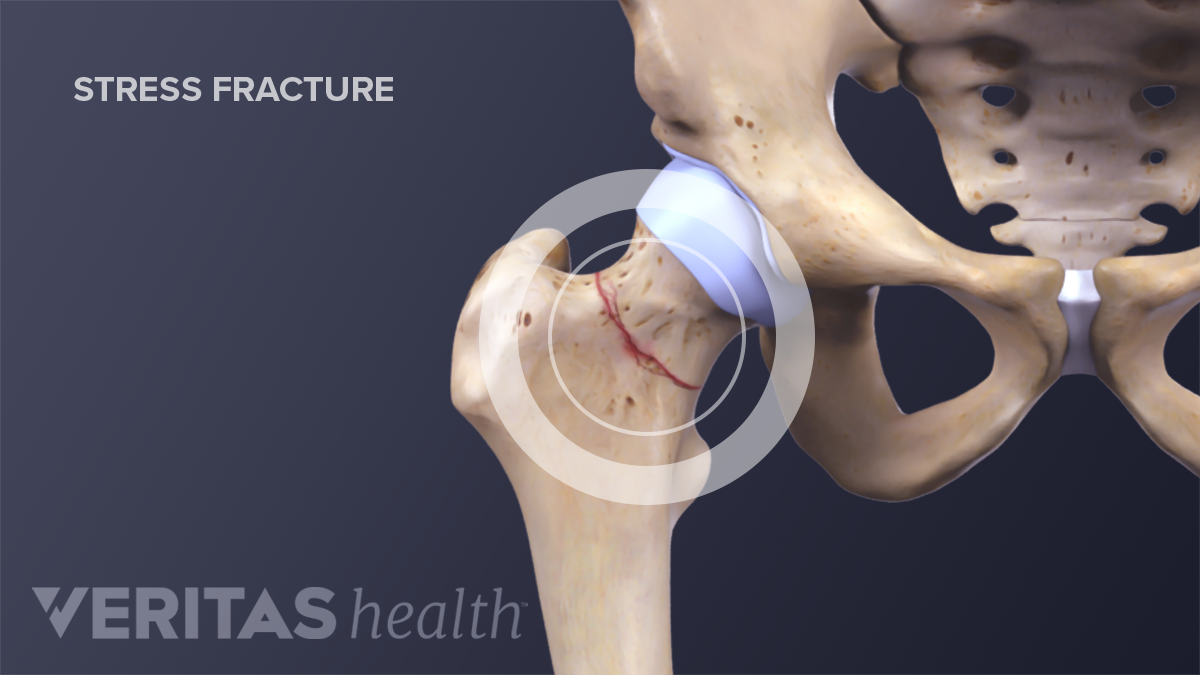 Stress Fracture of Foot Ankle El Paso  Osteoporosis  Broken Bones of the  Foot El Paso