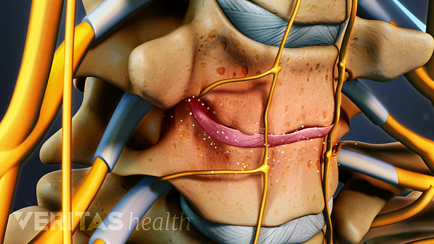 Inflamación por enfermedad degenerativa del disco cervical entre dos vértebras.