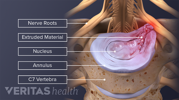 Illustration showing cervical herniated disc compressing the nerve