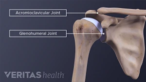 Acromioclavicular Joint Osteoarthritis Orlando, FL