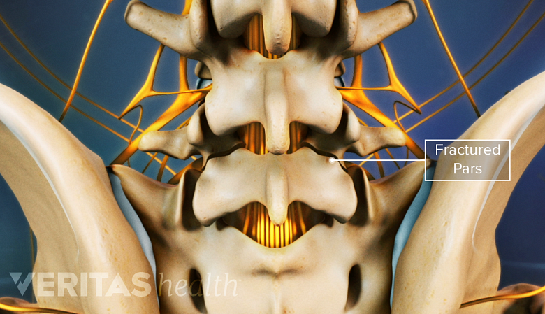 Illustration showing fractured pars interarticularis in the lumbar spine.
