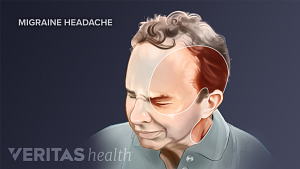 Illustration showing the swath of pain caused by a migraine headache