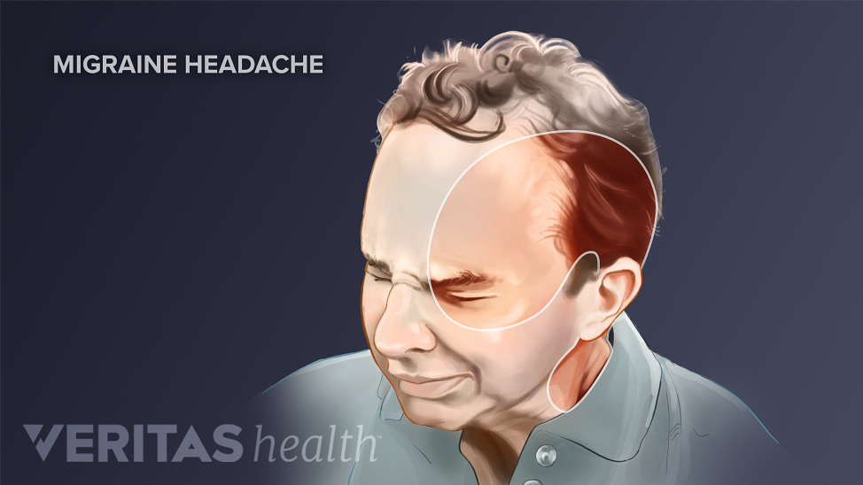 Diagram of man highlighting areas of the head and neck affected by a migraine.