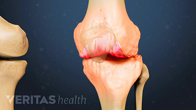 Medical illustration of a knee joint showing signs of osteoarthritis