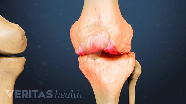 Medical illustration of a knee showing signs of painful osteoarthritis