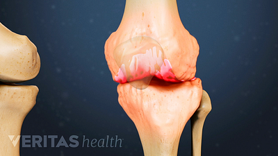 Medical illustration of a knee joint showing signs of osteoarthritis