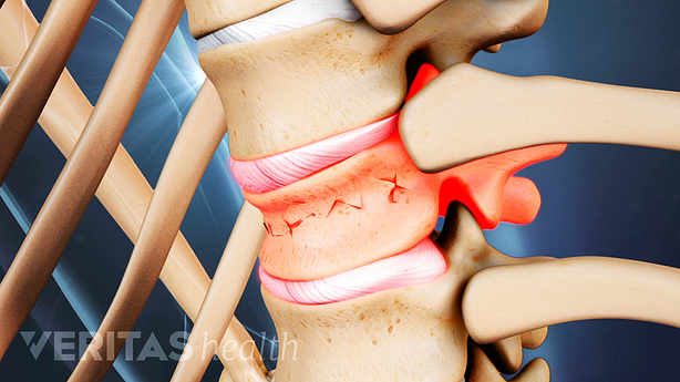 Close up medical illustration of a vertebrae with a compression fracture. The disc above the fracture is highlighted in red to indicate pain