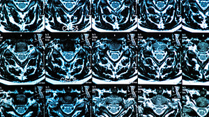 MRI扫描宫颈脊柱