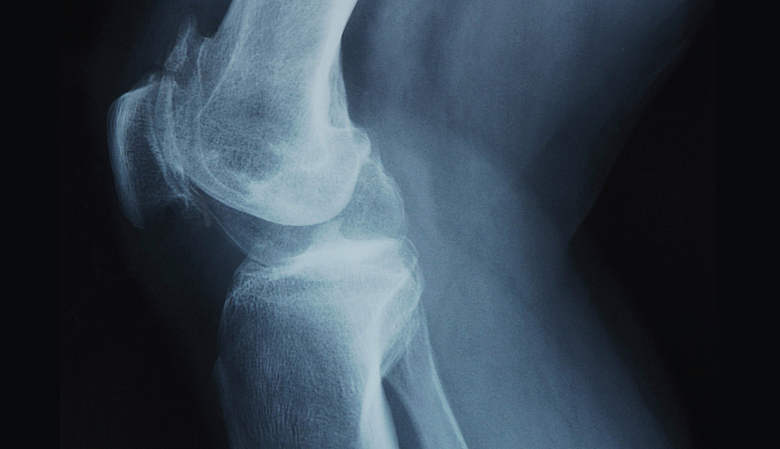 Illustration showing x-ray image of knee joint.