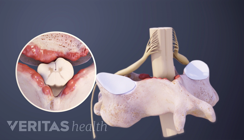 3D image of cervical vertebra with bone spurs.