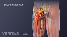 Medical illustration showing the sciatic nerve down the leg