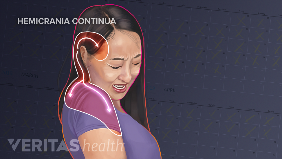 Diagram of woman highlighting areas of the head, shoulder and neck affected by a hemicrania continua headache.