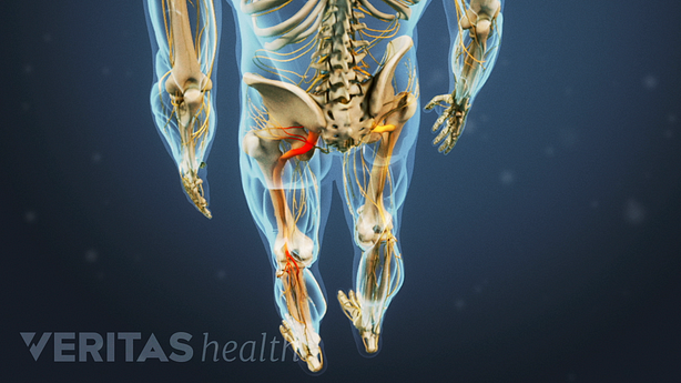 Medical illustration showing radiating pain down the leg in the sciatic nerve