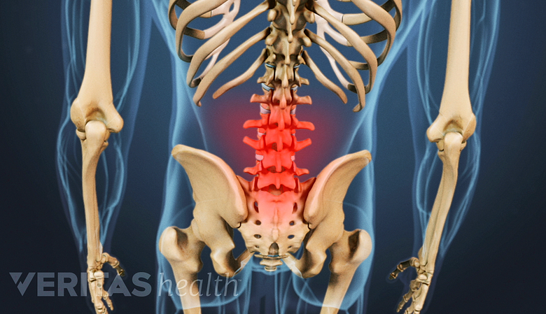 Medical illustration of the spine. The lumbar area is highlighted in red to indicate pain, numbness or tingling.