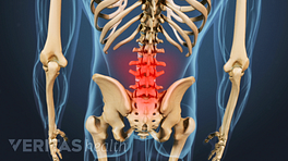 Posterior view of lower back with pain in the lumbar spine.