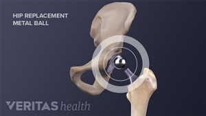 Illustration of a hip replacement, highlighting the metal ball that goes into the hip socket